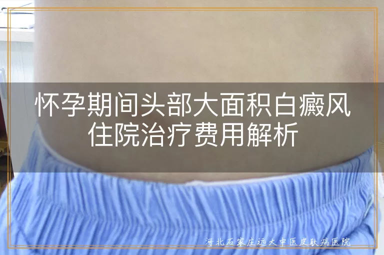 怀孕期白癜风治疗费用,头部白斑住院花费,孕期白斑综合治疗成本