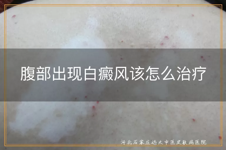 腹部白癜风治疗方法有哪些,白斑症状出现后的治疗策略,白癜风稳定期治疗手段