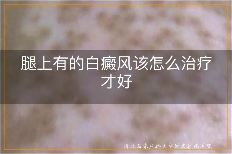 腿部白癜风科学治疗方法,白癜风腿上白斑如何治疗,腿上白斑白癜风治疗建议