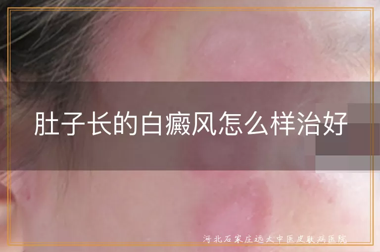 腹部白癜风综合治疗方案,肚子白斑如何科学治疗,白癜风患者日常护理要点