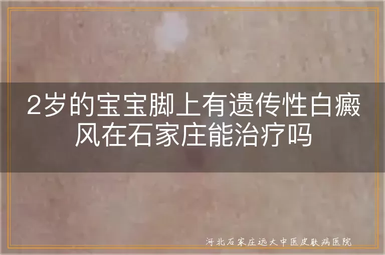 遗传性白癜风儿童治疗,石家庄白斑专科医院,两岁宝宝白癜风治疗