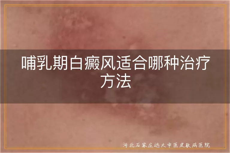 哺乳期白癜风物理治疗选择,白斑患者哺乳期用药方案,哺乳期白斑激光治疗安全性