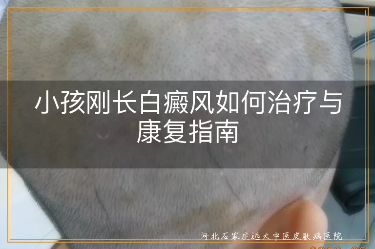 儿童白癜风早期治疗策略,儿童白斑康复护理要点,小儿白癜风综合干预方案