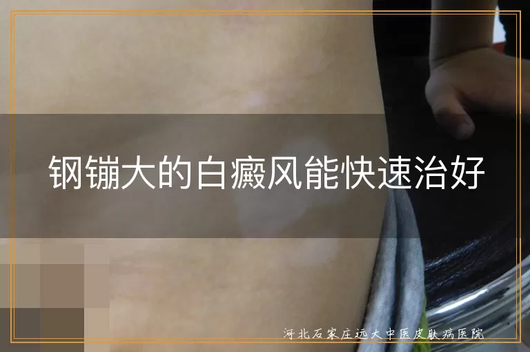 白癜风初期治疗效果如何,白斑面积小治疗周期,硬币大小白癜风恢复方法
