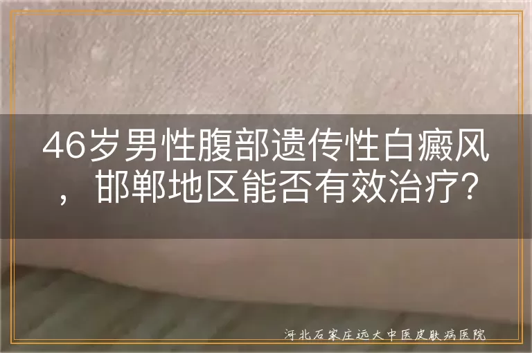 腹部遗传性白癜风治疗选择,邯郸地区白癜风综合诊疗方案,中年男性白癜风个性化治疗