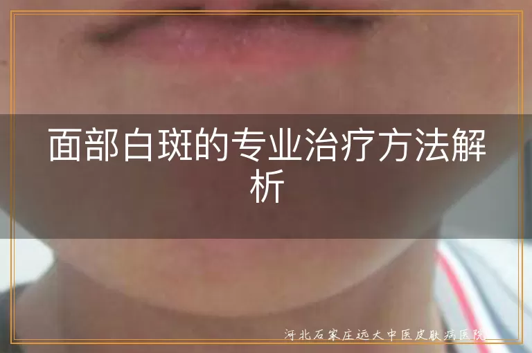 面部白斑综合治疗手段,白癜风分期诊疗策略,白斑中西医结合疗法