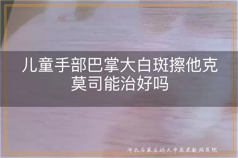 儿童手部白斑治疗方案,他克莫司治疗白癜风效果,儿童白癜风外用药物选择