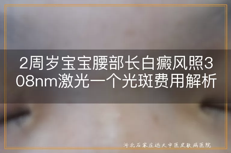 2周岁儿童腰部白斑308激光治疗费用,儿童白癜风308激光光斑价格咨询,宝宝腰部白癜风308激光单次费用