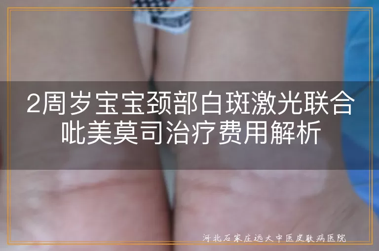 2周岁宝宝白癜风激光治疗费用,儿童颈部白斑激光联合用药成本,白癜风吡美莫司联合治疗价格