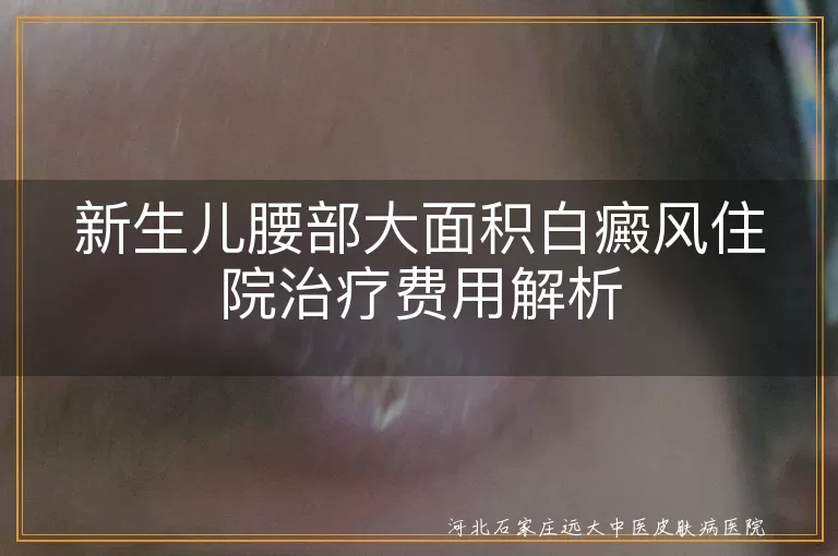 新生儿腰部大面积白癜风住院治疗费用解析