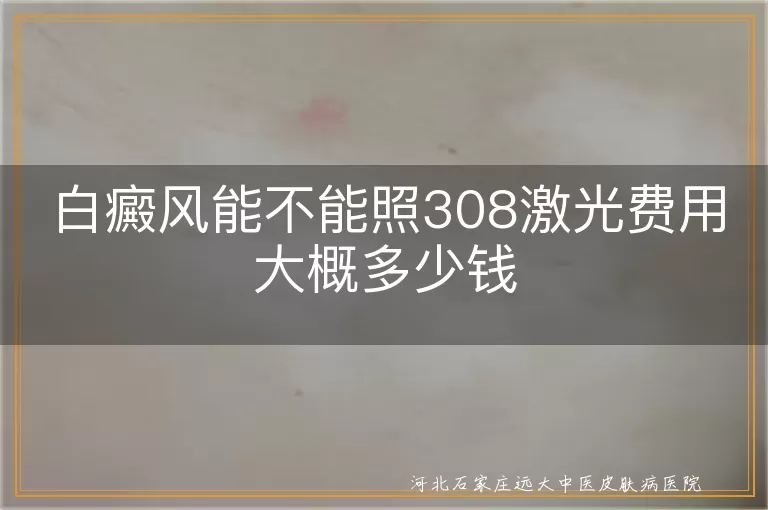 白癜风患者是否适用308激光治疗,白癜风308激光治疗费用影响因素,白斑308激光治疗费用区间咨询