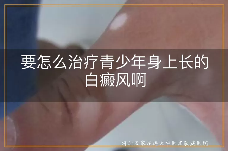 青少年白癜风科学治疗方案,青少年白斑综合治疗方法,青少年白癜风护理要点