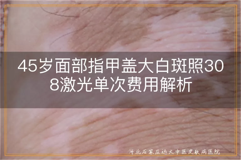 45岁面部指甲盖大白斑照308激光单次费用解析