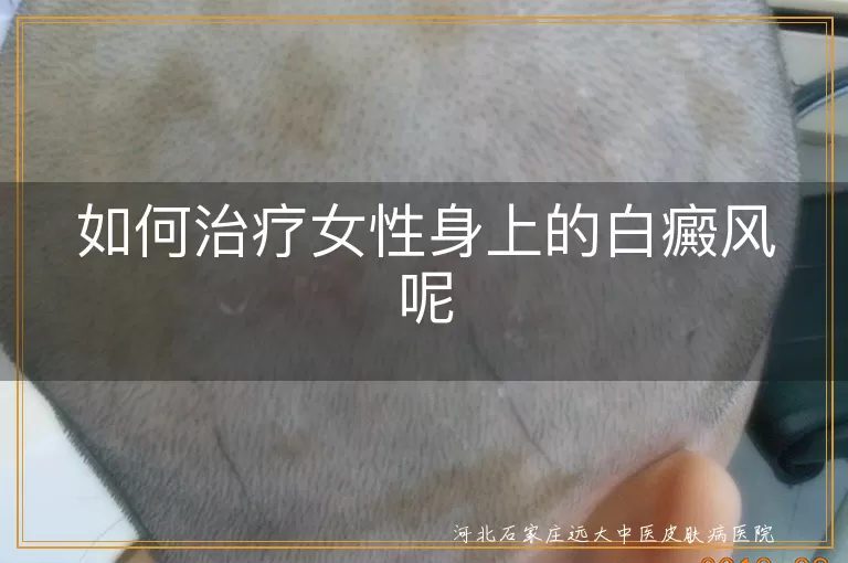 如何治疗女性身上的白癜风呢