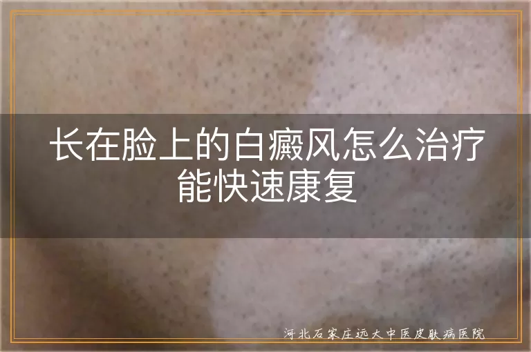 长在脸上的白癜风怎么治疗能快速康复
