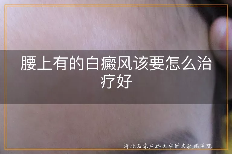 腰部白癜风综合治疗方式,腰上白斑如何科学治疗,白癜风腰部发病怎么应对
