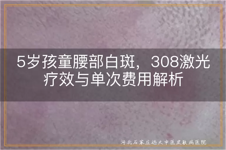 `5岁儿童腰部白斑308激光治疗费用,5岁孩子白斑照308激光效果,儿童白癜风308激光照射成本`