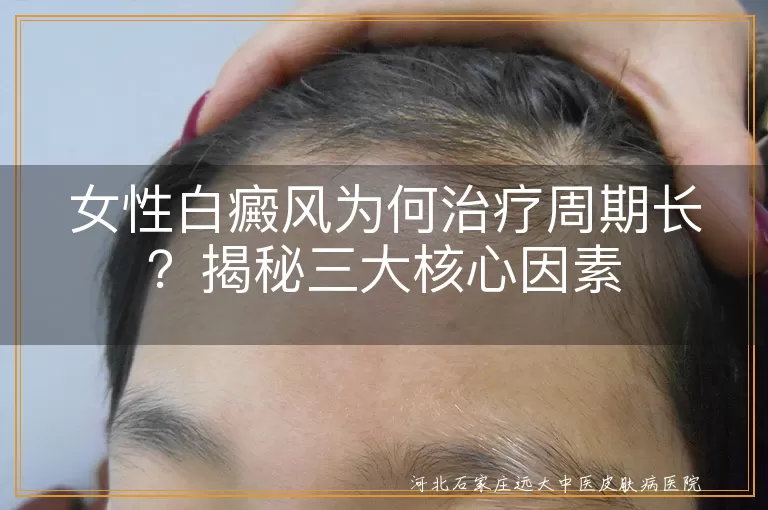 女性白癜风为何治疗周期长？揭秘三大核心因素
