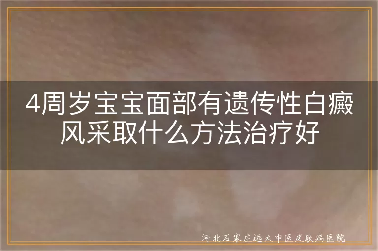 4周岁宝宝面部有遗传性白癜风采取什么方法治疗好