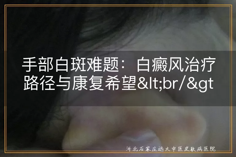 手部白癜风综合治疗策略,白斑疾病治愈可能性分析,肢端型白癜风管理方案