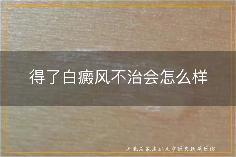 `白癜风拖延不治会有什么危害,白斑放任不管会怎样,白癜风久拖有什么后果`
