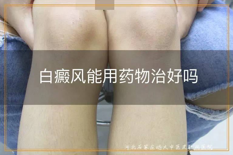 白癜风口服药疗效可靠吗,白斑抹药多久能恢复,白癜风药物怎么选