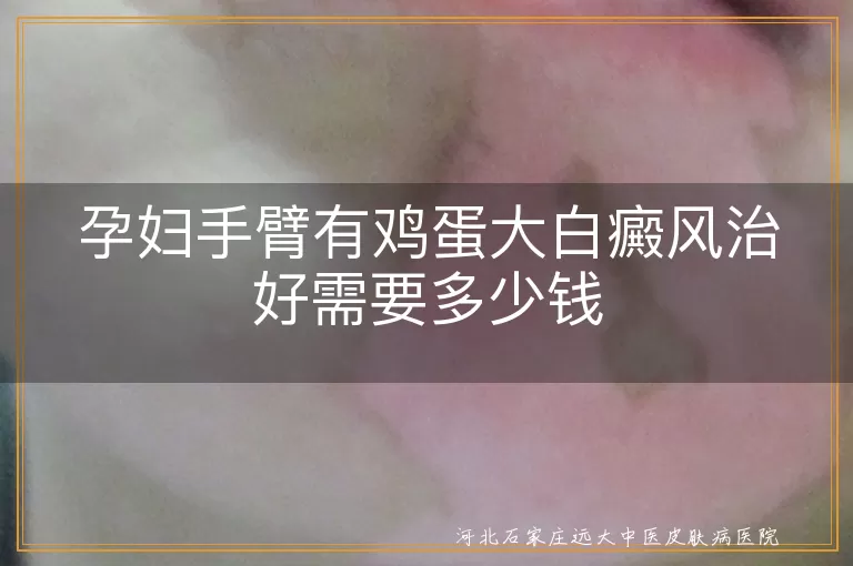 孕妇手臂白斑治疗花费,鸡蛋大白癜风康复周期,孕期白癜风保守疗法