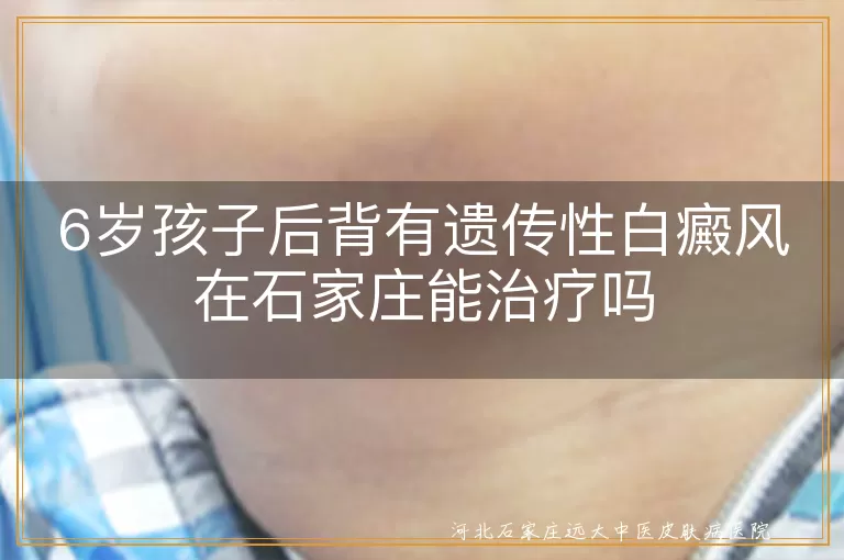 家族遗传白癜风能治,幼儿后背白斑恢复,石家庄儿童白斑干预