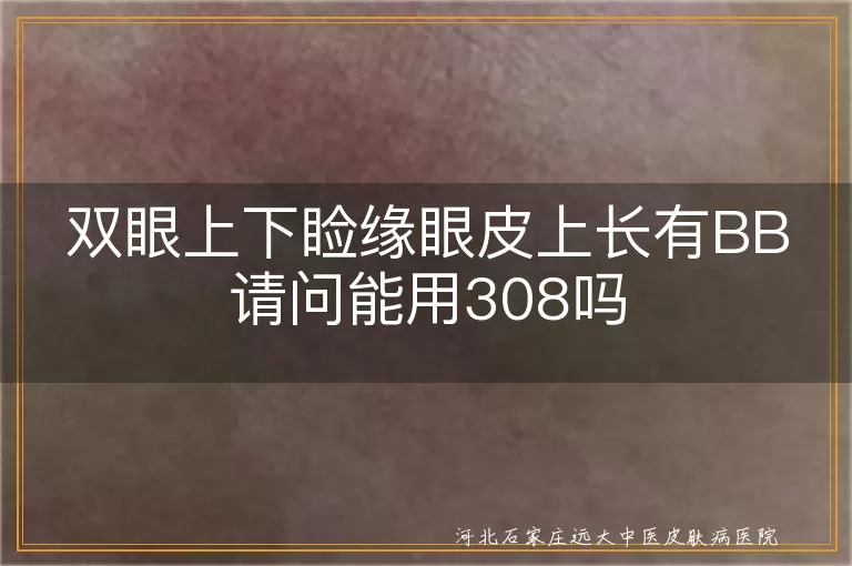 白斑睑缘能否照308,白癜风眼部激光忌讳,眼皮白斑准分子光安全性