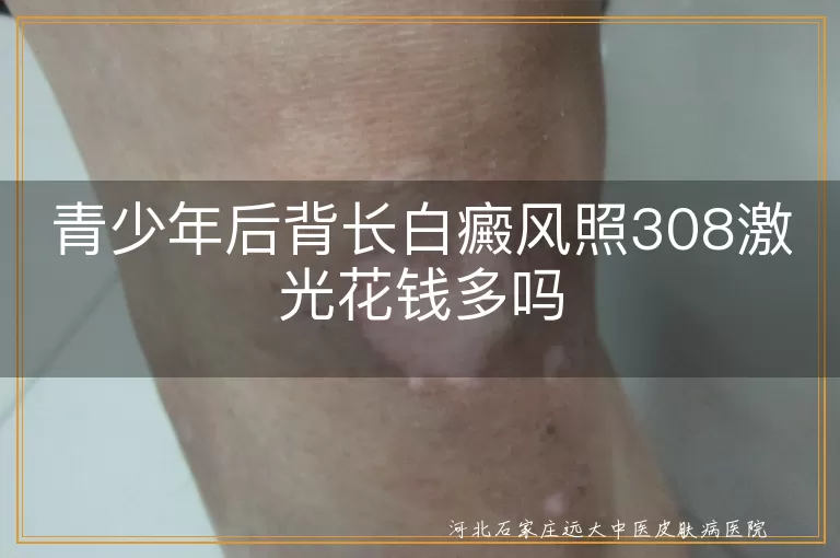 青少年后背白癜风308激光贵吗,青少年患白斑激光价格,后背白癜风308花费