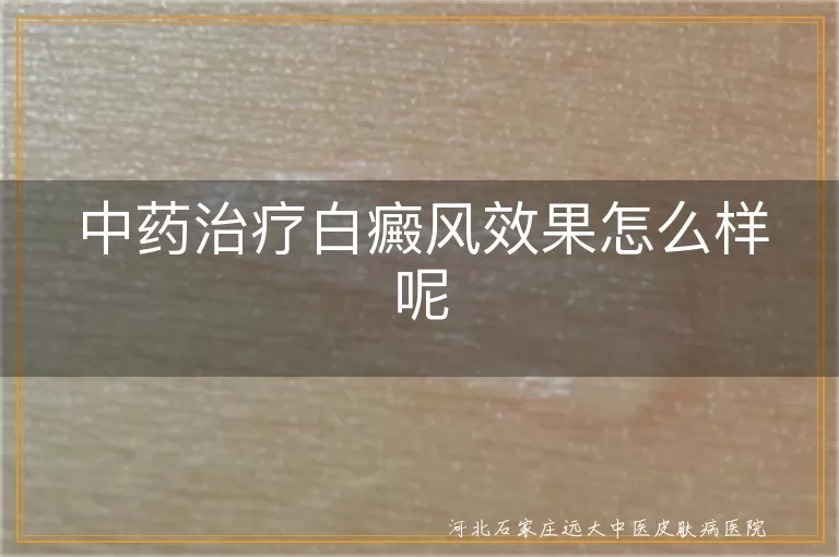 白癜风中药疗法靠谱吗,白斑中西医结合效果评估,中药调理白癜风作用解析