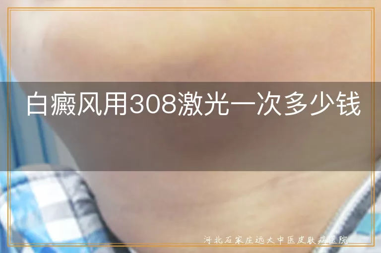 白癜风308激光收费,白斑308激光疗程价,白癜风光疗价格