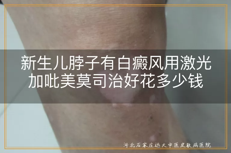 新生儿脖子白斑治疗见效快,激光配合吡美莫司治白癜风,婴儿白斑费用估算