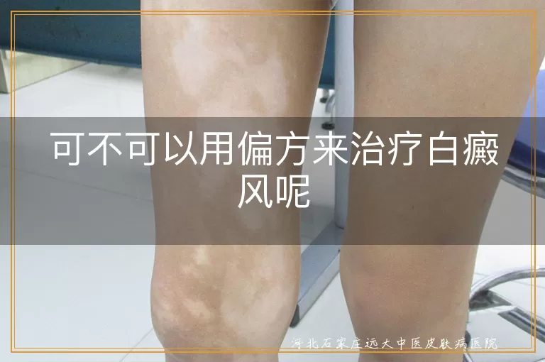 不要轻信白斑偏方,白癜风民间疗法真相,白斑治疗选择慎思