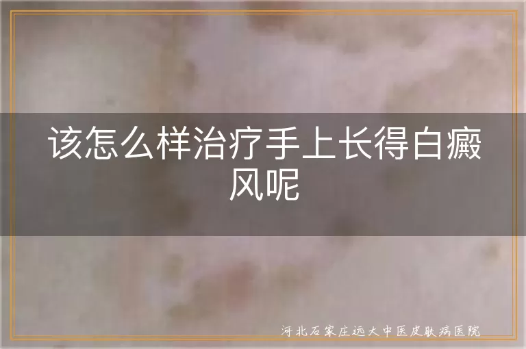 手上白斑治疗技巧,白癜风手部复色方法,手指白癜风日常调理