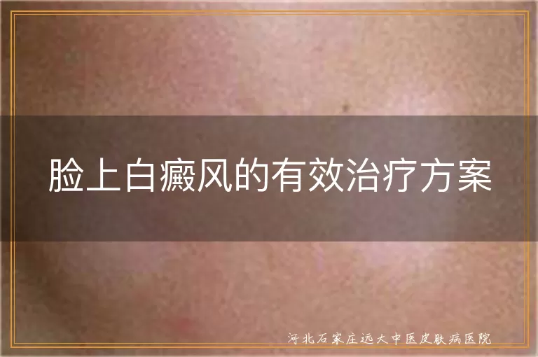 脸上白癜风修复攻略,面部白斑光照策略,白癜风中医外治妙方