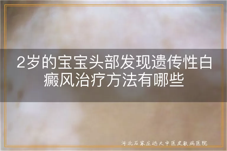 宝宝头部白斑应对策略,遗传性白癜风早期干预,婴幼儿白癜风温和疗法