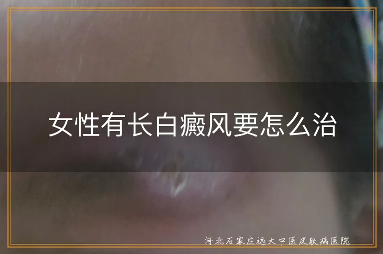 白癜风早期症状及女性调护,白斑稳定期女性治疗策略,女性白癜风联合疗法效果