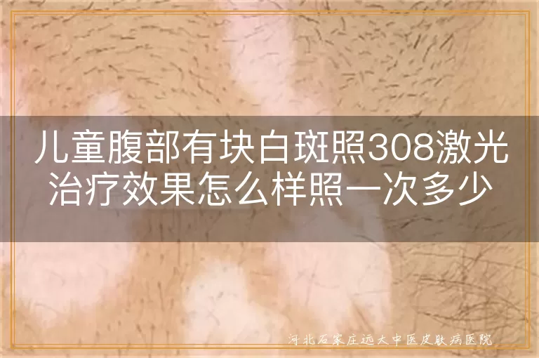 小儿腹白斑激光疗法效果如何,白癜风308光疗一次多少钱,腹部白斑儿童照光频率