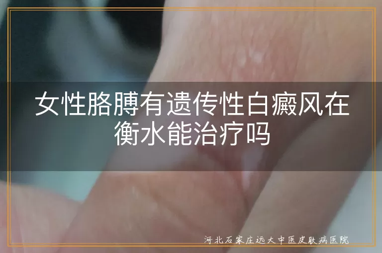 女性胳膊有遗传性白癜风在衡水能治疗吗