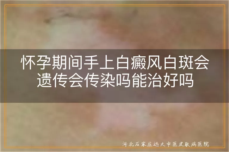 孕期手上白斑风险,白癜风会不会传给宝宝,怀孕期白斑可以控制吗