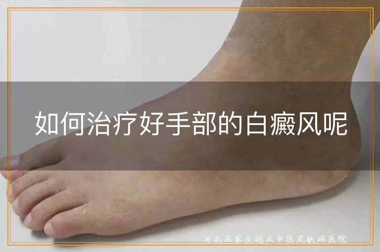手部白斑治愈策略,白癜风护理重点,手指节白斑光照方案