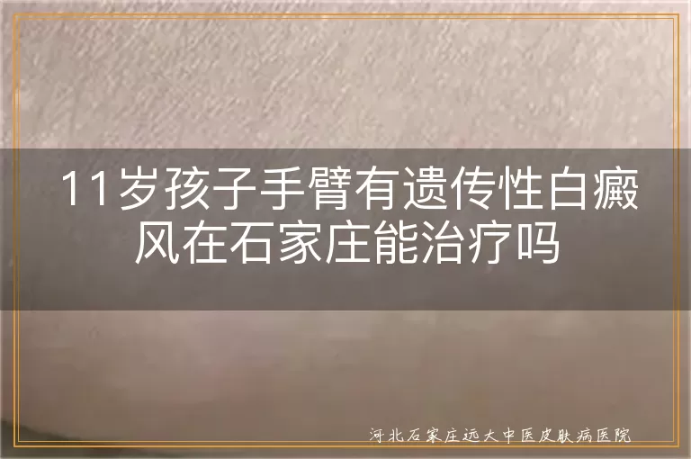 11岁孩子手臂有遗传性白癜风在石家庄能治疗吗