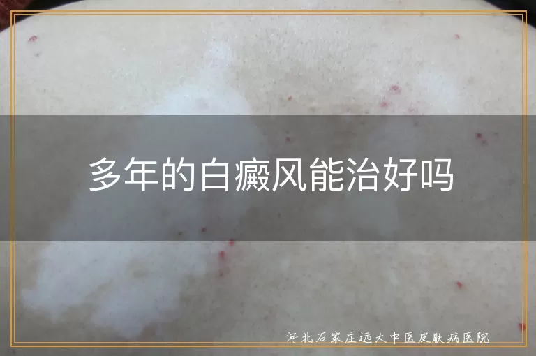 多年的白癜风能治好吗