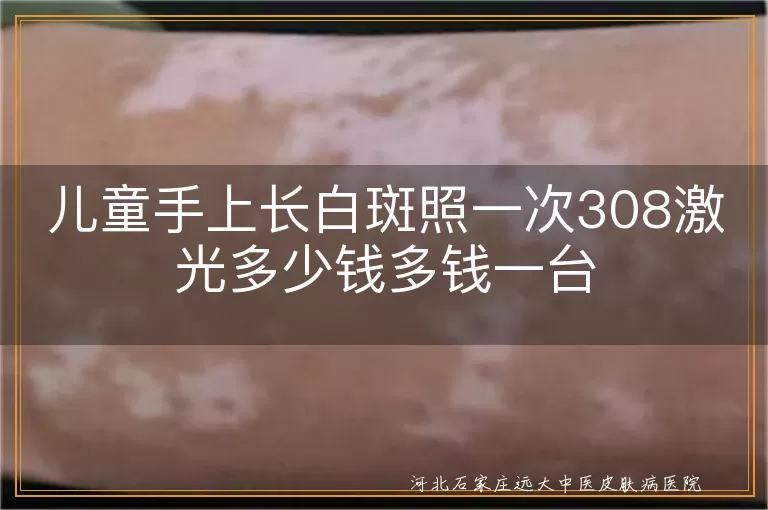 白癜风308照一次收费,儿童白斑激光大概多少钱,308设备治疗白癜风价位