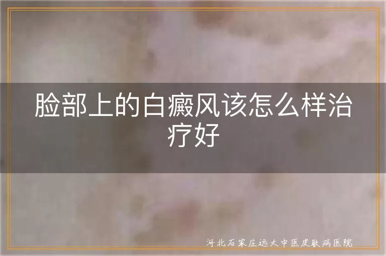 脸部白斑如何祛除,面部白癜风疗法指南,脸颊白癜风治疗攻略