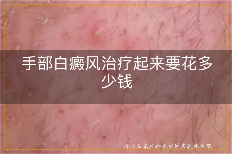 手部白癜风医疗费用解析,白斑治疗费用详解,白癜风手部治疗开销揭秘