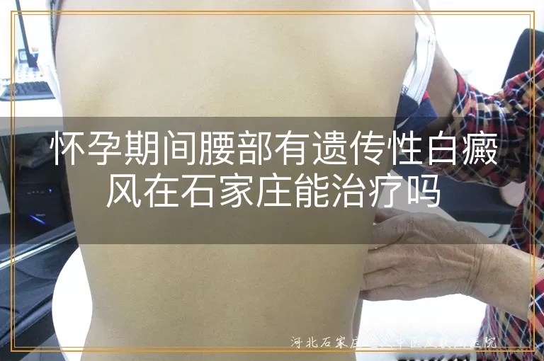 怀孕期间腰部有遗传性白癜风在石家庄能治疗吗