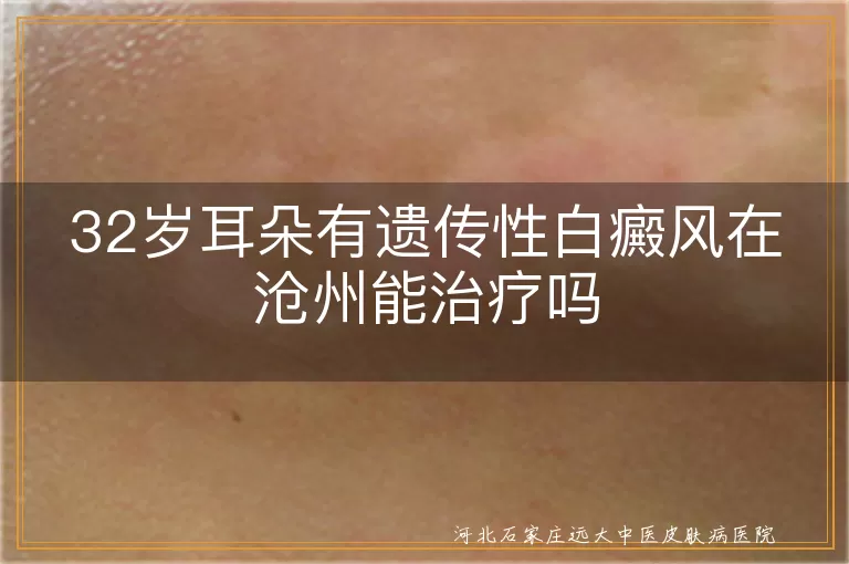 沧州耳朵遗传性白斑治疗,32岁女性耳部白癜风方案,遗传性白癜风沧州可行吗