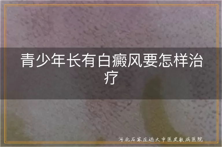 青少年白斑护理攻略,青春期白癜风复色路径,学生群体白斑干预思路